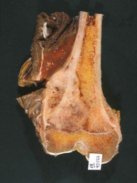Osteosarcoma of the distal femur in a young patient treated with pre-operative chemotherapy and a limb-sparing surgical procedure. <i>(click to enlarge)</i> Osteosarcoma of the distal femur in a young patient treated with pre-operative chemotherapy and a limb-sparing surgical procedure. <i>(click to enlarge)</i>