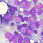 AML cells