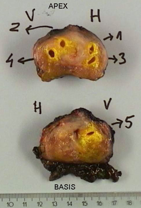 Sampling of multiple tissue cores from a prostatectomy specimen