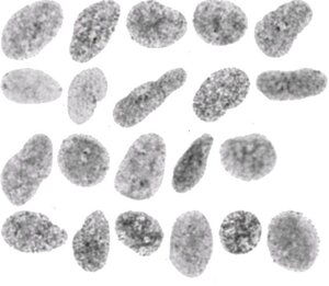 Tumor nuclei as seen in ploidy measurements.
