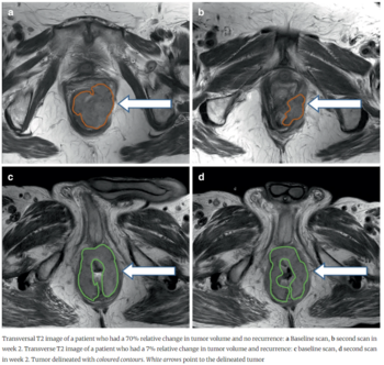 Transversal T2 image of a patient who had a 70% relative change in tumor volume and no recurrence: a Baseline scan, b second scan in week 2. Transverse T2 image of a patient who had a 7% relative change in tumor volume and recurrence: c baseline scan, d second scan in week 2. Tumor delineated with coloured contours. White arrows point to the delineated tumor